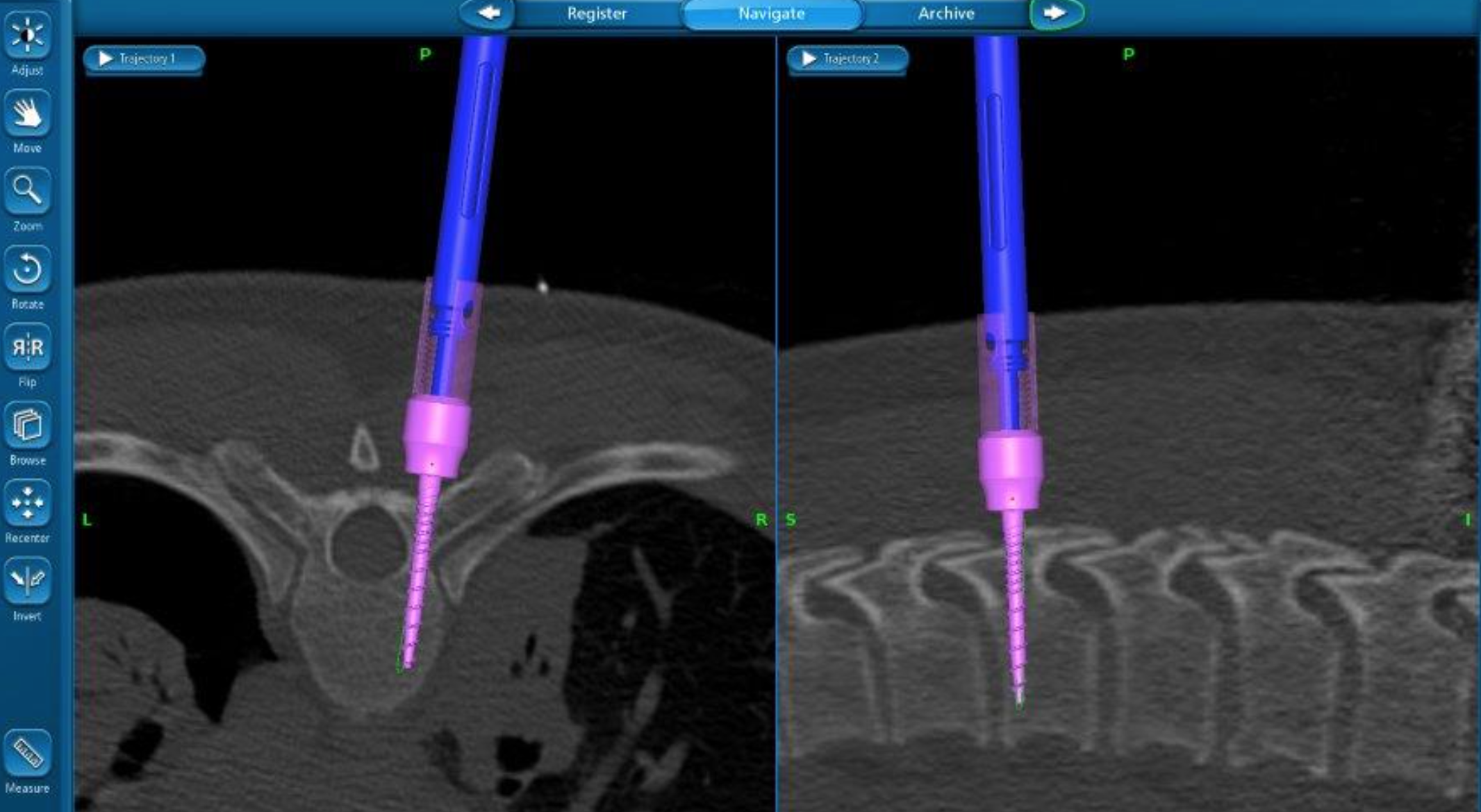 The management of spinal trauma